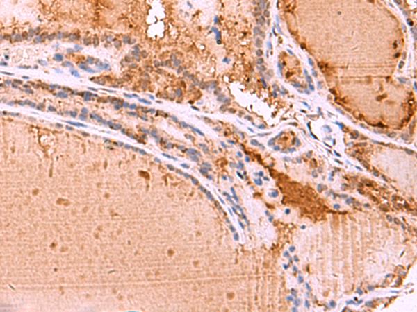 HTRA4 Antibody - Immunohistochemistry of paraffin-embedded Human thyroid cancer tissue  using HTRA4 Polyclonal Antibody at dilution of 1:35(×200)