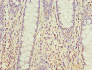 HUM2DD / DHDH Antibody - Immunohistochemistry of paraffin-embedded human colon cancer at dilution 1:100