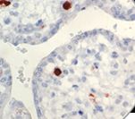 Human Parvovirus Antibody - IHC of Parvovirus B19 on FFPE Infected Placenta tissue.