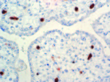 Human Parvovirus Antibody - IHC of Parvovirus B19 on an FFPE Infected Placenta Tissue