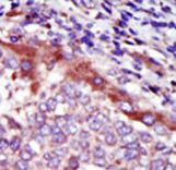 HUNK / B19 Antibody - Formalin-fixed and paraffin-embedded human cancer tissue reacted with the primary antibody, which was peroxidase-conjugated to the secondary antibody, followed by AEC staining. This data demonstrates the use of this antibody for immunohistochemistry; clinical relevance has not been evaluated. BC = breast carcinoma; HC = hepatocarcinoma.