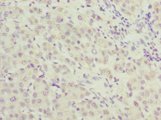 HUPF2 / UPF2 Antibody - Immunohistochemistry of paraffin-embedded human liver cancer at dilution 1:100