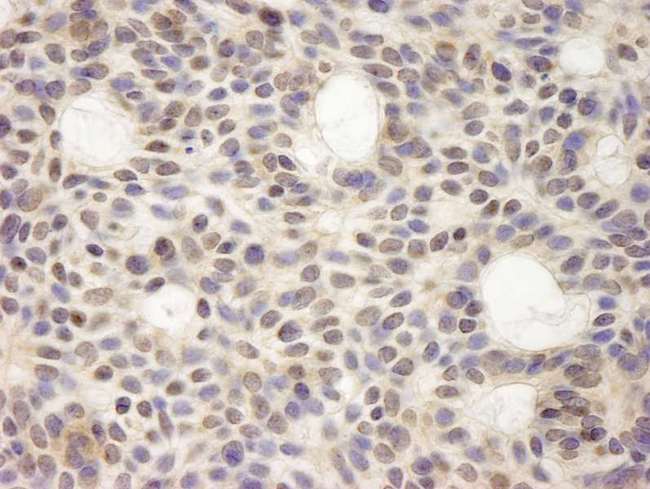 HURP / DLGAP5 Antibody - Detection of Human HURP/DLG7 by Immunohistochemistry. Sample: FFPE section of human basal cell carcinoma. Antibody: Affinity purified rabbit anti-HURP/DLG7 used at a dilution of 1:250.