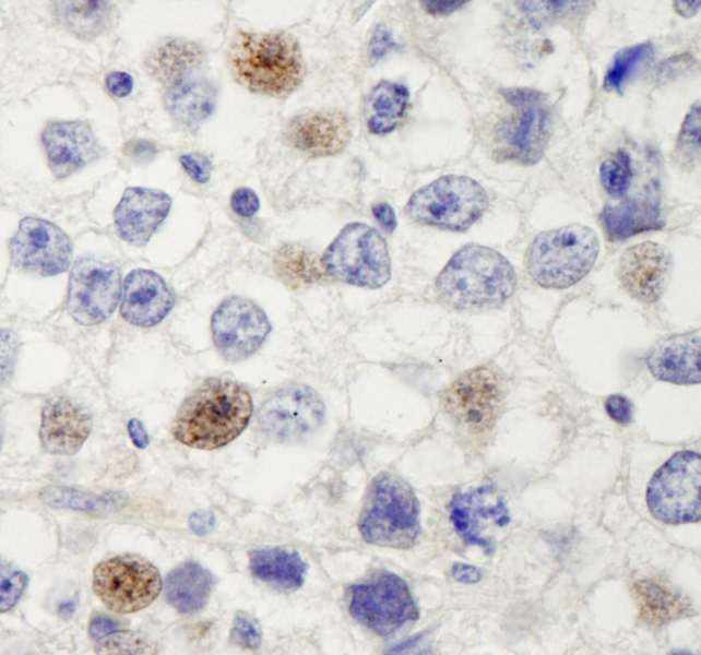 HURP / DLGAP5 Antibody - Detection of Human HURP/DLG7 by Immunohistochemistry. Sample: FFPE section of human seminoma. Antibody: Affinity purified rabbit anti-HURP/DLG7 used at a dilution of 1:250.