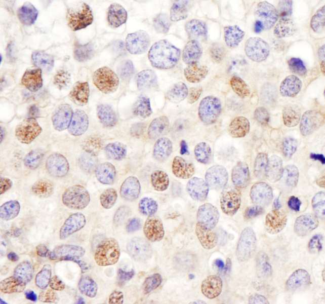 HURP / DLGAP5 Antibody - Detection of Human HURP/DLG7 by Immunohistochemistry. Sample: FFPE section of human breast carcinoma. Antibody: Affinity purified rabbit anti-HURP/DLG7 used at a dilution of 1:200 (1 ug/ml). Detection: DAB.