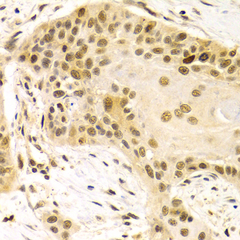 HURP / DLGAP5 Antibody - Immunohistochemistry of paraffin-embedded human esophageal cancer tissue.