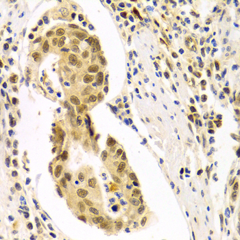 HURP / DLGAP5 Antibody - Immunohistochemistry of paraffin-embedded Human gastric cancer tissue.