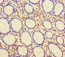 HUS1 Antibody - Immunohistochemistry of paraffin-embedded human gastric cancer using HUS1 Antibody at dilution of 1:100