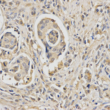HUS1 Antibody - Immunohistochemistry of paraffin-embedded human stomach cancer tissue.