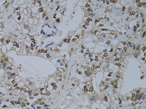 HUS1 Antibody - Immunohistochemistry of paraffin-embedded human gastric cancer using HUS1 antibody at dilution of 1:100 (40x lens).
