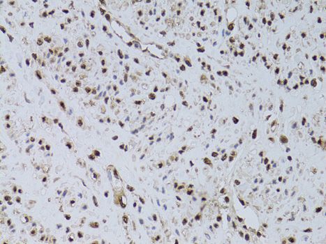 HUS1 Antibody - Immunohistochemistry of paraffin-embedded human uterine cancer using HUS1 antibody at dilution of 1:100 (40x lens).