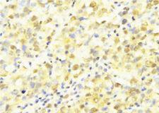 HUS1 Antibody - 1:100 staining human breast carcinoma tissue by IHC-P. The sample was formaldehyde fixed and a heat mediated antigen retrieval step in citrate buffer was performed. The sample was then blocked and incubated with the antibody for 1.5 hours at 22°C. An HRP conjugated goat anti-rabbit antibody was used as the secondary.