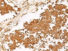 HUS1 Antibody - Immunohistochemistry of paraffin-embedded Human lung cancer tissue  using HUS1 Polyclonal Antibody at dilution of 1:65(×200)