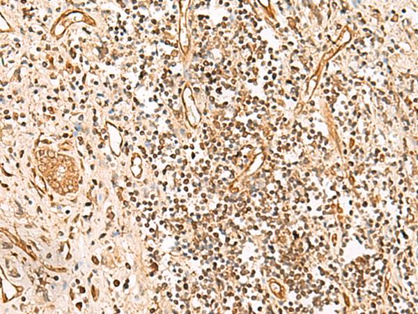 HUS1 Antibody - Immunohistochemistry of paraffin-embedded Human prost ate cancer tissue  using HUS1 Polyclonal Antibody at dilution of 1:65(×200)
