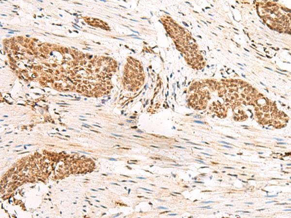 HUS1 Antibody - Immunohistochemistry of paraffin-embedded Human esophagus cancer tissue  using HUS1 Polyclonal Antibody at dilution of 1:45(×200)