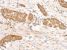 HUS1 Antibody - Immunohistochemistry of paraffin-embedded Human esophagus cancer tissue  using HUS1 Polyclonal Antibody at dilution of 1:45(×200)