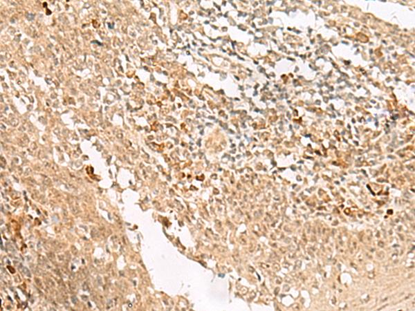 HUS1 Antibody - Immunohistochemistry of paraffin-embedded Human tonsil tissue  using HUS1 Polyclonal Antibody at dilution of 1:45(×200)