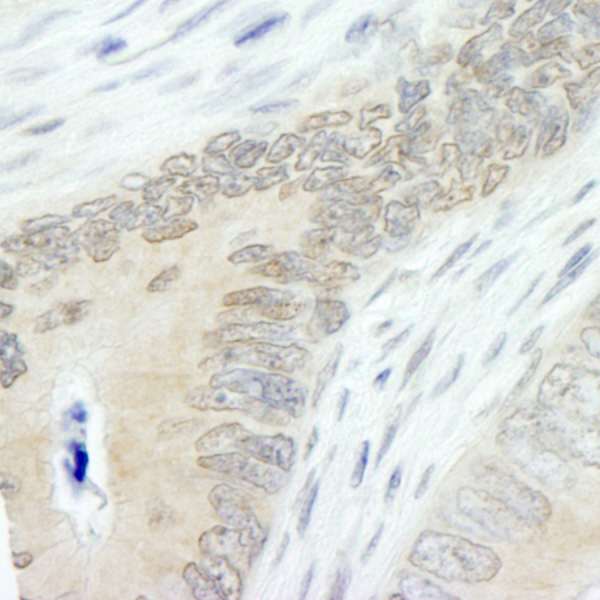 HUWE1 / ARFBP1 Antibody - Detection of Human Lasu1/Ureb1 by Immunohistochemistry. Sample: FFPE section of human colon carcinoma. Antibody: Affinity purified rabbit anti-Lasu1/Ureb1 used at a dilution of 1:250.