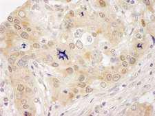 HUWE1 / ARFBP1 Antibody - Detection of Human Lasu1/Ureb1 by Immunohistochemistry. Sample: FFPE section of human ovarian carcinoma. Antibody: Affinity purified rabbit anti-Lasu1/Ureb1 used at a dilution of 1:1000 (1 ug/ml). Detection: DAB.