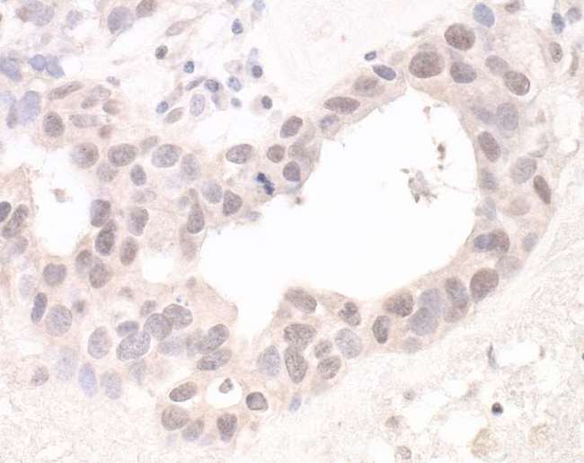 HUWE1 / ARFBP1 Antibody - Detection of human Lasu1/Ureb1 by immunohistochemistry. Sample: FFPE section of human ovarian carcinoma. Antibody: Affinity purified rabbit anti-Lasu1/Ureb1 used at a dilution of 1:5,000 (0.2µg/ml). Detection: DAB.