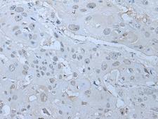 HUWE1 / ARFBP1 Antibody - Immunohistochemistry of paraffin-embedded Human esophagus cancer tissue  using HUWE1 Polyclonal Antibody at dilution of 1:30(×200)