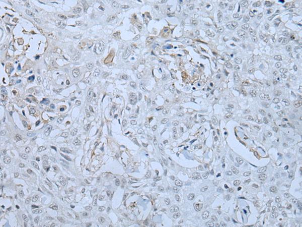 HUWE1 / ARFBP1 Antibody - Immunohistochemistry of paraffin-embedded Human lung cancer tissue  using HUWE1 Polyclonal Antibody at dilution of 1:30(×200)