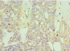 HYAL1 Antibody - Immunohistochemistry of paraffin-embedded human endometrial cancer using antibody at 1:100 dilution.