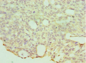 HYAL1 Antibody - Immunohistochemistry of paraffin-embedded human endommetrial cancer using HYAL1 Antibody at dilution of 1:100