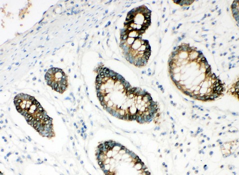 HYAL1 Antibody - HYAL1 antibody IHC-paraffin: Human Intestinal Cancer Tissue.