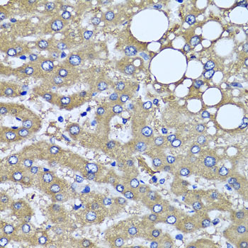 HYAL1 Antibody - Immunohistochemistry of paraffin-embedded human liver injury tissue.
