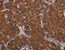HYAL2 Antibody - Immunohistochemistry of paraffin-embedded Human renal cancer using HYAL2 Polyclonal Antibody at dilution of 1:60.