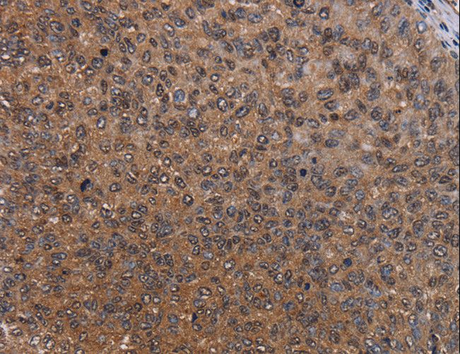 HYAL2 Antibody - Immunohistochemistry of paraffin-embedded Human renal cancer using HYAL2 Polyclonal Antibody at dilution of 1:60.