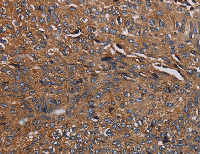 HYAL2 Antibody - Immunohistochemistry of paraffin-embedded Human ovarian cancer using HYAL2 Polyclonal Antibody at dilution of 1:40.