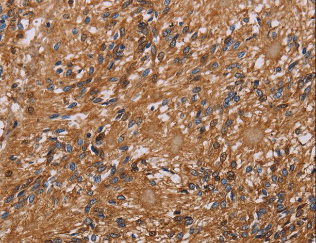 HYAL2 Antibody - Immunohistochemistry of paraffin-embedded Human ovarian cancer using HYAL2 Polyclonal Antibody at dilution of 1:40.