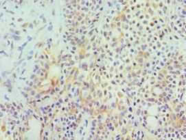 HYAL3 Antibody - Immunohistochemistry of paraffin-embedded human breast cancer using antibody at 1:100 dilution.