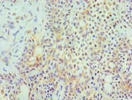 HYAL3 Antibody - Immunohistochemistry of paraffin-embedded human breast cancer using HYAL3 Antibody at dilution of 1:100
