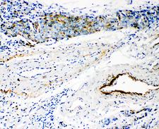 HYAL3 Antibody - HYAL3 antibody. IHC(P): Human Breast Cancer Tissue.