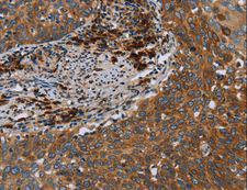 HYAL3 Antibody - Immunohistochemistry of paraffin-embedded Human cervical cancer using HYAL3 Polyclonal Antibody at dilution of 1:40.