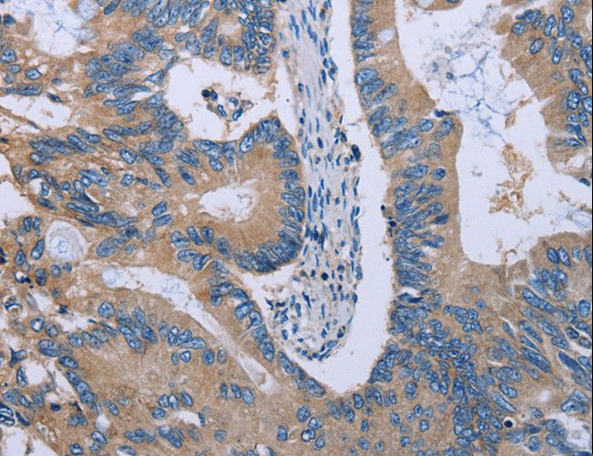 HYAL3 Antibody - Immunohistochemistry of paraffin-embedded Human colon cancer using HYAL3 Polyclonal Antibody at dilution of 1:40.