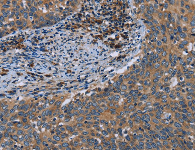 HYAL3 Antibody - Immunohistochemistry of paraffin-embedded Human cervical cancer using HYAL3 Polyclonal Antibody at dilution of 1:40.