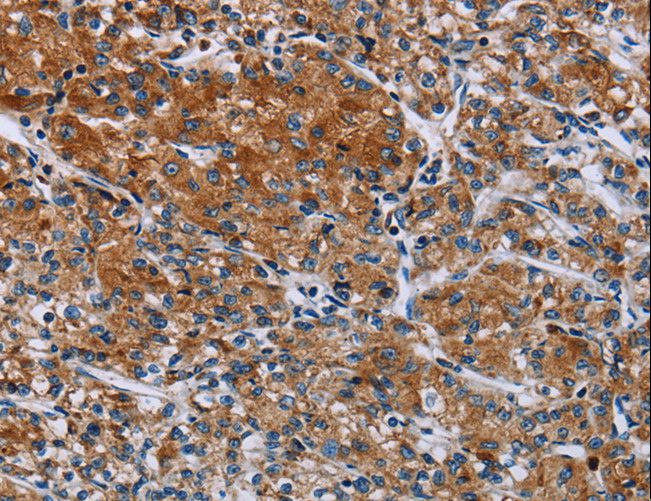 HYAL3 Antibody - Immunohistochemistry of paraffin-embedded Human prostate cancer using HYAL3 Polyclonal Antibody at dilution of 1:40.