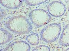HYOU1 / ORP150 Antibody - Immunohistochemistry of paraffin-embedded human colon cancer using antibody at 1:100 dilution.