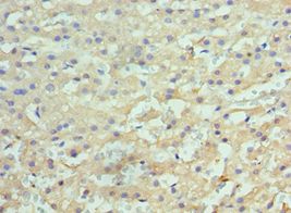 HYOU1 / ORP150 Antibody - Immunohistochemistry of paraffin-embedded human liver cancer using antibody at 1:100 dilution.