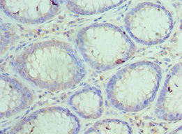 HYOU1 / ORP150 Antibody - Immunohistochemistry of paraffin-embedded human colon cancer using HYOU1 Antibody at dilution of 1:100