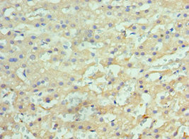 HYOU1 / ORP150 Antibody - Immunohistochemistry of paraffin-embedded human liver cancer using HYOU1 Antibody at dilution of 1:100