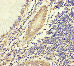 HYPM / CXorf27 Antibody - Immunohistochemistry of paraffin-embedded human colon cancer using HYPM Antibody at dilution of 1:100