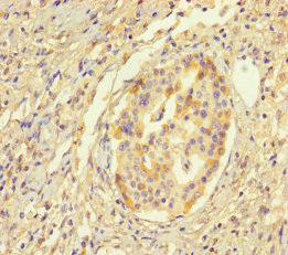 HYPM / CXorf27 Antibody - Immunohistochemistry of paraffin-embedded human pancreatic cancer using HYPM Antibody at dilution of 1:100
