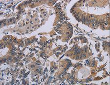 I-309 / CCL1 Antibody - Immunohistochemistry of paraffin-embedded Human cervical cancer using CCL1 Polyclonal Antibody at dilution of 1:50.