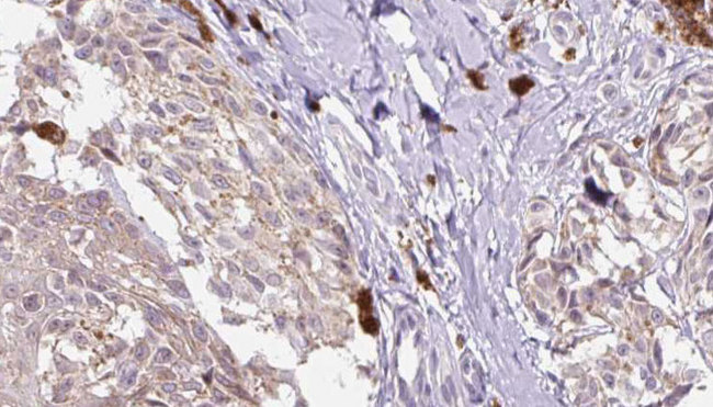 I-309 / CCL1 Antibody - 1:100 staining human Melanoma tissue by IHC-P. The sample was formaldehyde fixed and a heat mediated antigen retrieval step in citrate buffer was performed. The sample was then blocked and incubated with the antibody for 1.5 hours at 22°C. An HRP conjugated goat anti-rabbit antibody was used as the secondary.