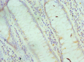 I-BABP / FABP6 Antibody - Immunohistochemistry of paraffin-embedded human colon cancer using FABP6 Antibody at dilution of 1:100